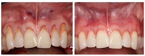 Gum Surgery in Philippines • Check Prices & Reviews .